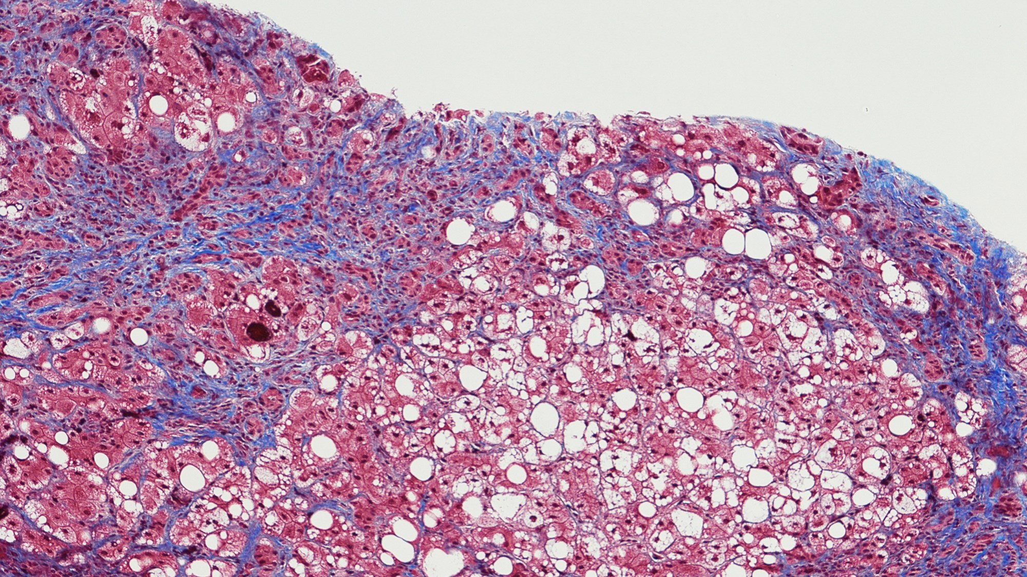 Hepatitis Virus unter Mikroskop.
